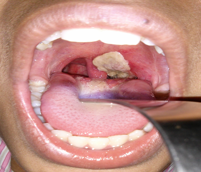 difteria