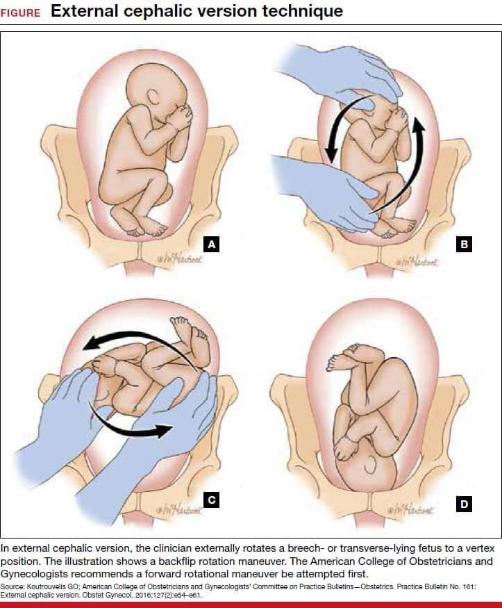 Imej amaran larangan memusingkan bayi songsang dalam kandungan