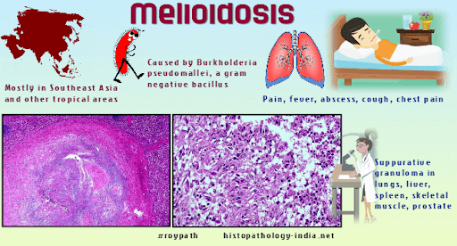 Imej infografik fakta penyakit melioidosis