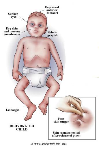 Imej berkaitan persoalan penyakit rotavirus pada kanak-kanak.
