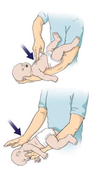 Demonstrasi langkah pertama CPR atau Heimlich maneuver pada bayi