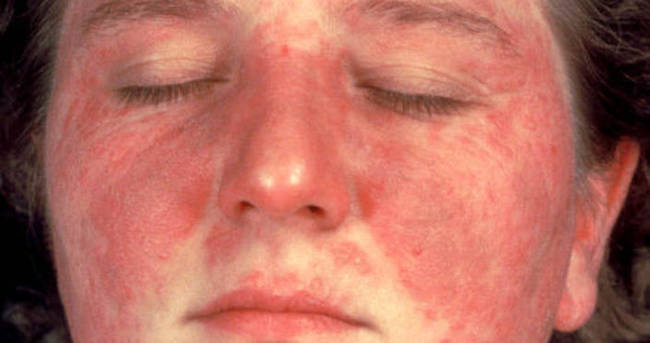 Gambaran pesakit menghidap penyakit SLE (Lupus) dengan tompok merah pada wajah.