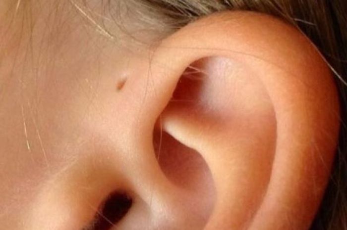 Gambar menunjukkan kecacatan preauricular sinus iaitu lubang kecil di bahagian hadapan telinga.