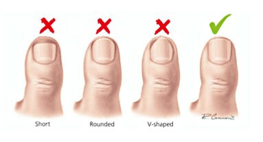 Gambar berkaitan tips untuk mencegah cagu kuku kaki (ingrown toenail).