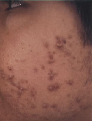 Jerawat biasa atau acne vulgaris pada wajah