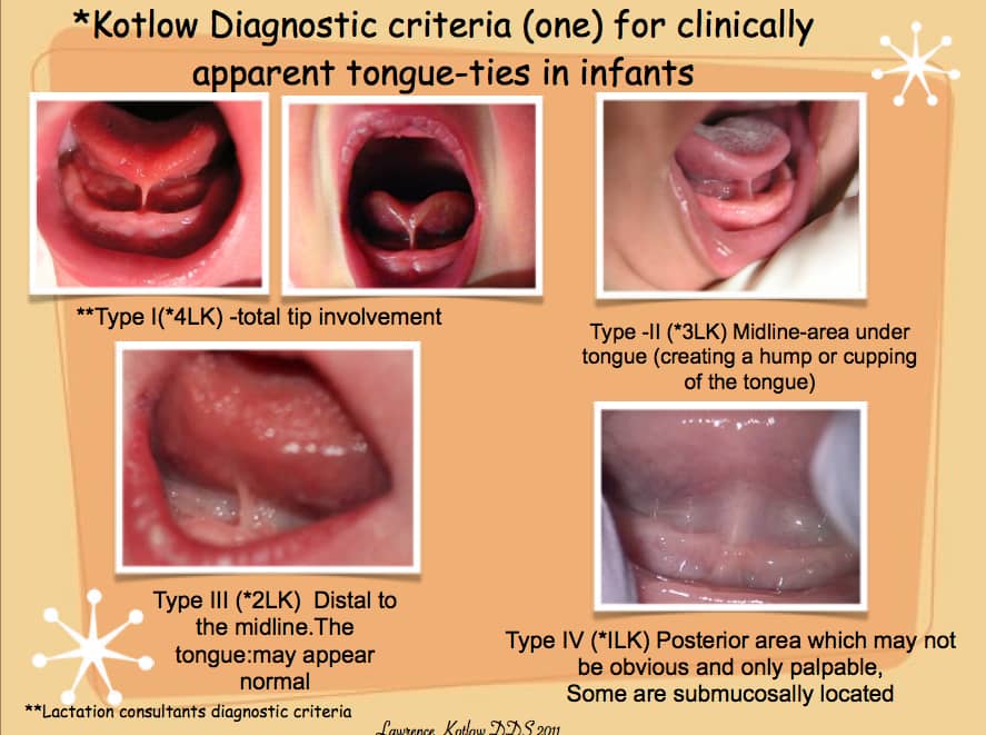Gambar menunjukkan mulut bayi yang mempunyai masalah tongue tie.