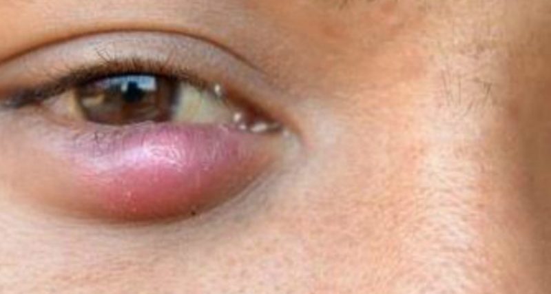 Gambar rajah menunjukkan jenis ketumbit stye dan chalazion pada kelopak mata
