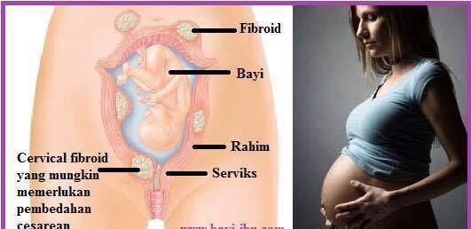 Infografik fakta mengenai fibroid dan kesannya semasa kehamilan