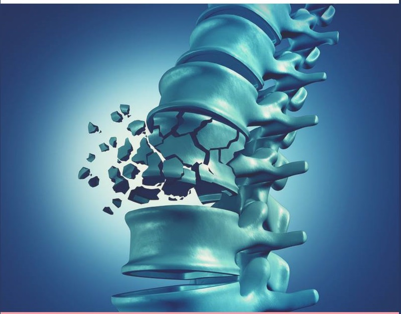 Gambar berkaitan faktor-faktor tulang rapuh atau osteoporosis dengan ilustrasi tulang manusia.