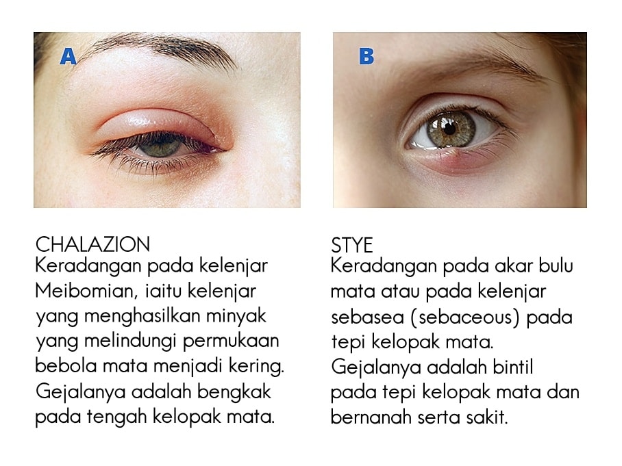 jenis ketumbit