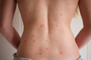 ruam pityriasis rosea