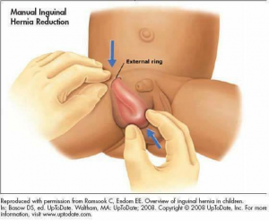 cegah hernia