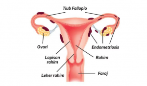 ketumbuhan endometriosis