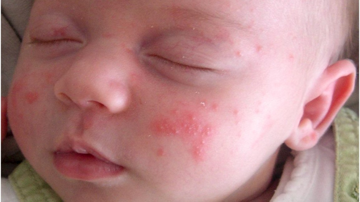 Bayi sedang tidur dengan ruam merah pada kulit pipi dan muka
