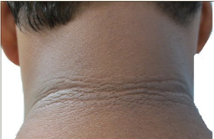 Ilustrasi leher hitam berkerak akibat masalah acanthosis nigricans