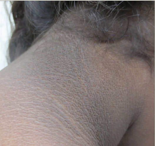 Kulit leher yang gelap dan hitam menunjukkan tanda Acanthosis Nigricans