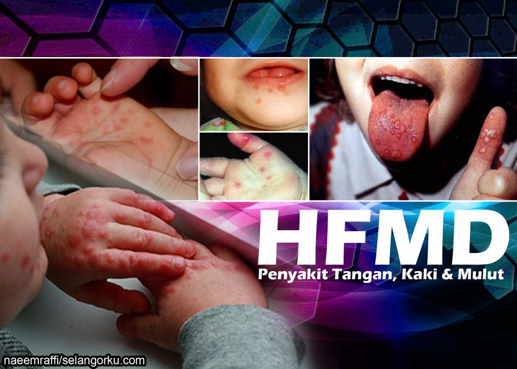 Tangan kanak-kanak dengan ruam dan lepuh akibat HFMD