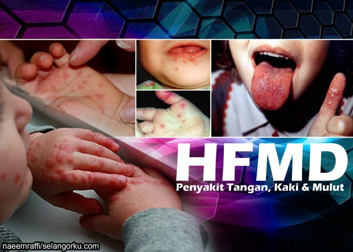 Gambar anak kecil yang sedang sakit serta ringkasan info penyakit HFMD