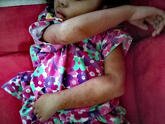 Kanak-kanak perempuan dengan bintik purpura di kaki akibat penyakit HSP.