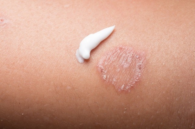 krim antifungal terbaik