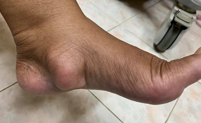 Benjolan kecil pada bahagian kaki