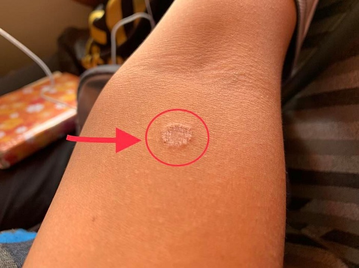 Gambaran kesan jangkitan kulit kurap pada permukaan badan