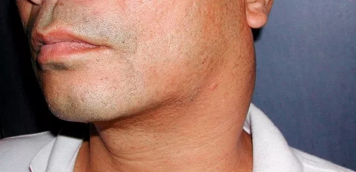 Kanser Hidung