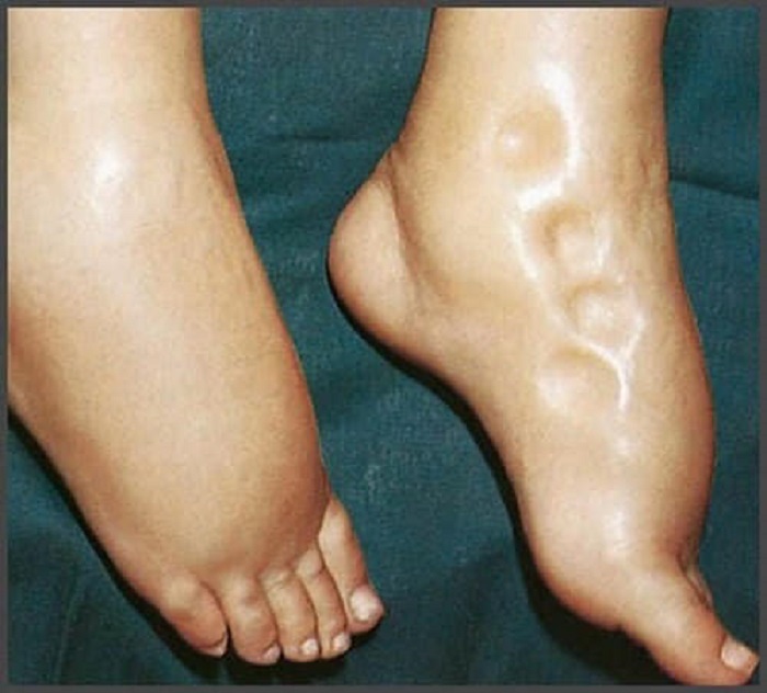 kaki bengkak