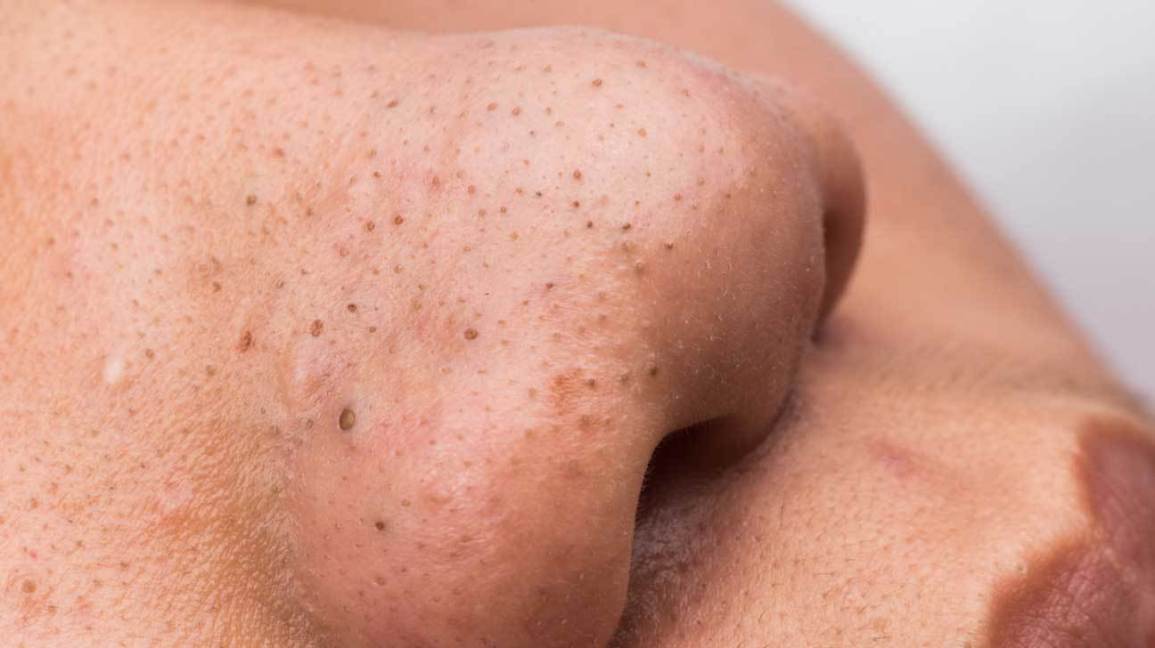 Gambarajah close-up blackhead pada kulit muka manusia