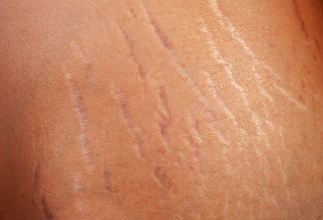 petua hilangkan stretch mark