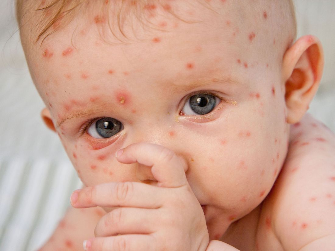 Bayi sedang tidur dengan ruam merah akibat demam campak di seluruh badan.