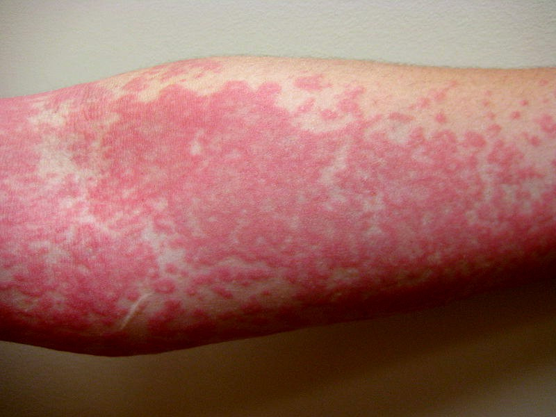 Ilustrasi kulit bertanda merah akibat gegata (urticaria) pada tangan