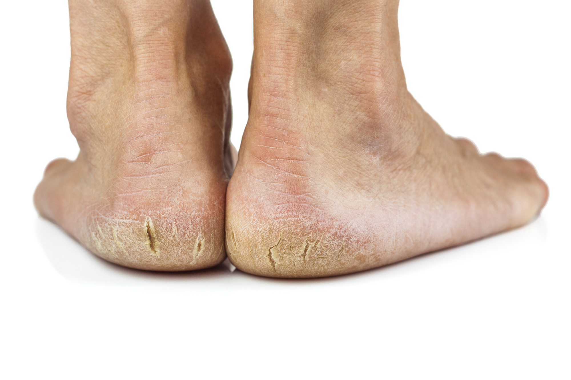 Gambar tumit kaki yang kering dan merekah