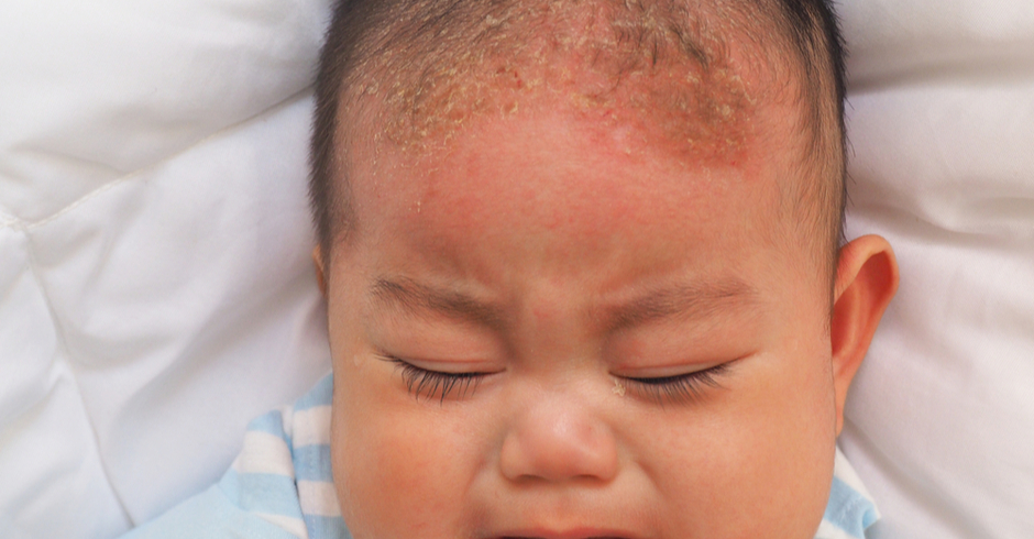 Kulit kepala bayi yang mempunyai kerak dan kuping (cradle cap)