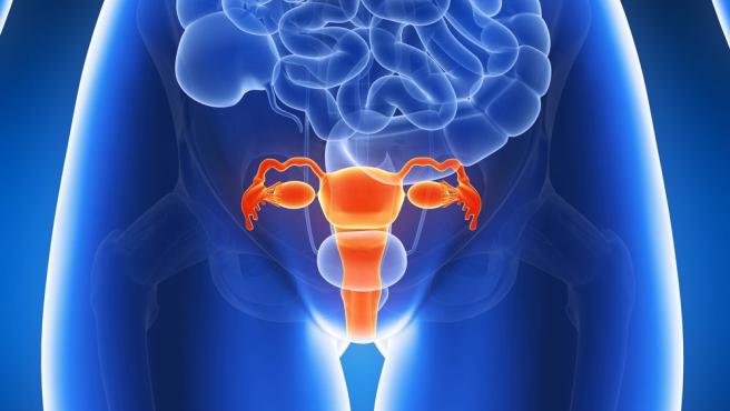 Gambar rajah berkaitan ketumbuhan endometriosis pada organ reproduktif wanita
