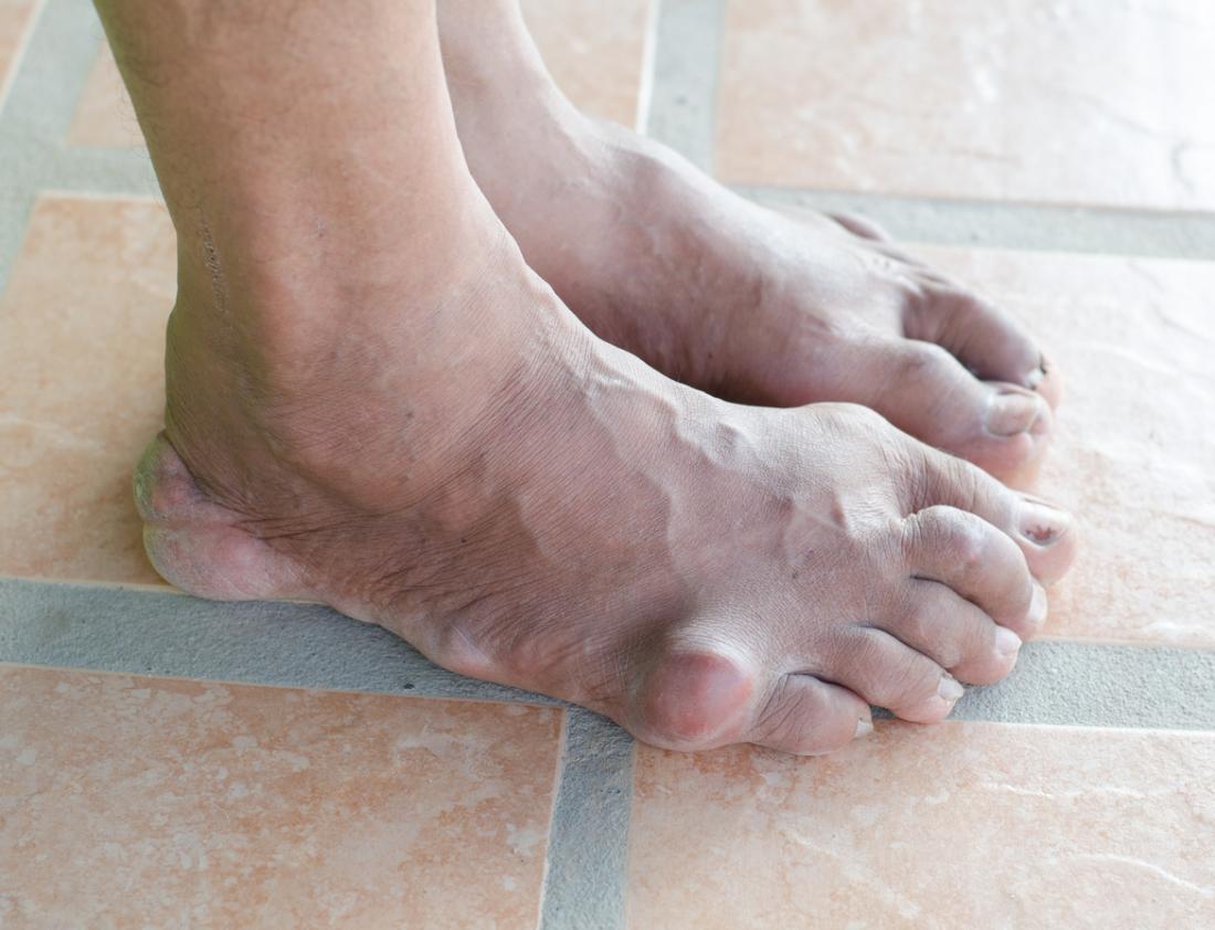 Ilustrasi kesakitan gout pada bahagian tumit dan kaki