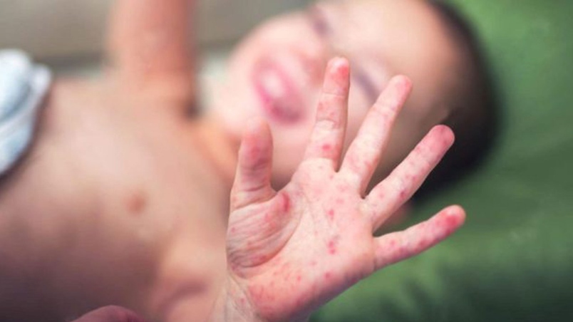 Gambar related to HFMD menunjukkan ulser di mulut dan bintik merah pada tapak tangan kanak-kanak.
