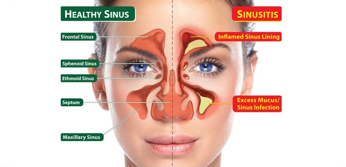 sinusitis