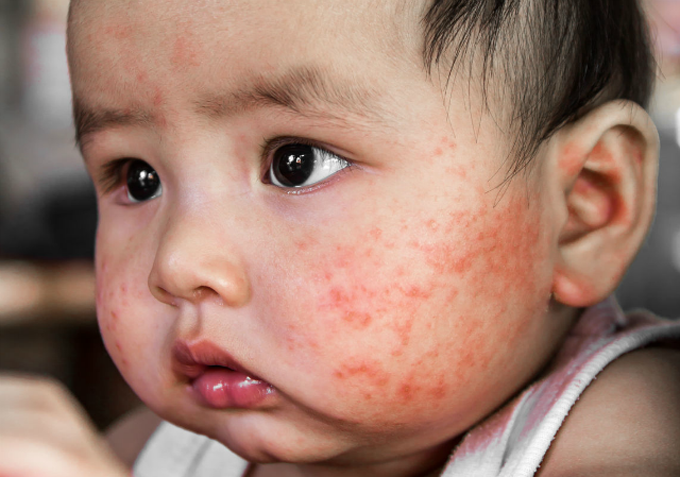 Gambar kulit pesakit mengalami masalah penyakit psoriasis eritrodermik yang merah dan bersisik.