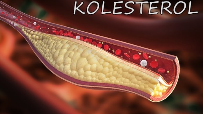 Ilustrasi salur darah tersumbat akibat kolesterol tinggi