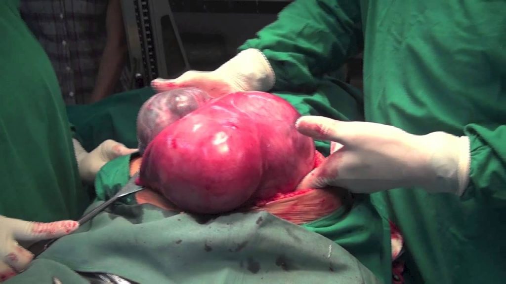 punca cyst