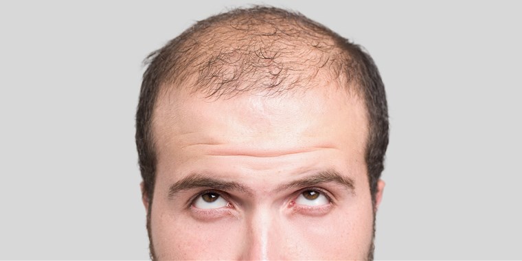 Wanita memegang rambut yang gugur sebagai simbol masalah keguguran rambut.