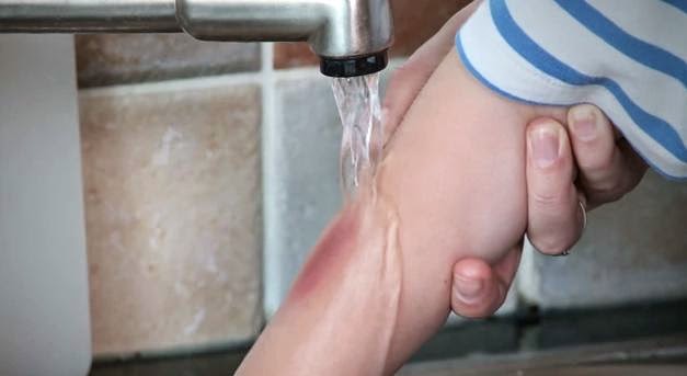 Gambar rawatan awal untuk kelecuran di anggota badan