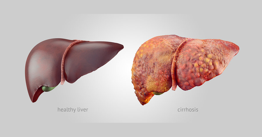 cirrhosis