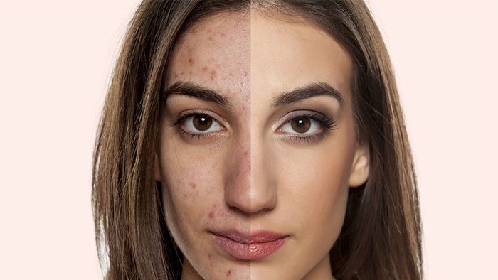Gambar hiasan wanita memegang wajah berkaitan tips menghilangkan parut jerawat.