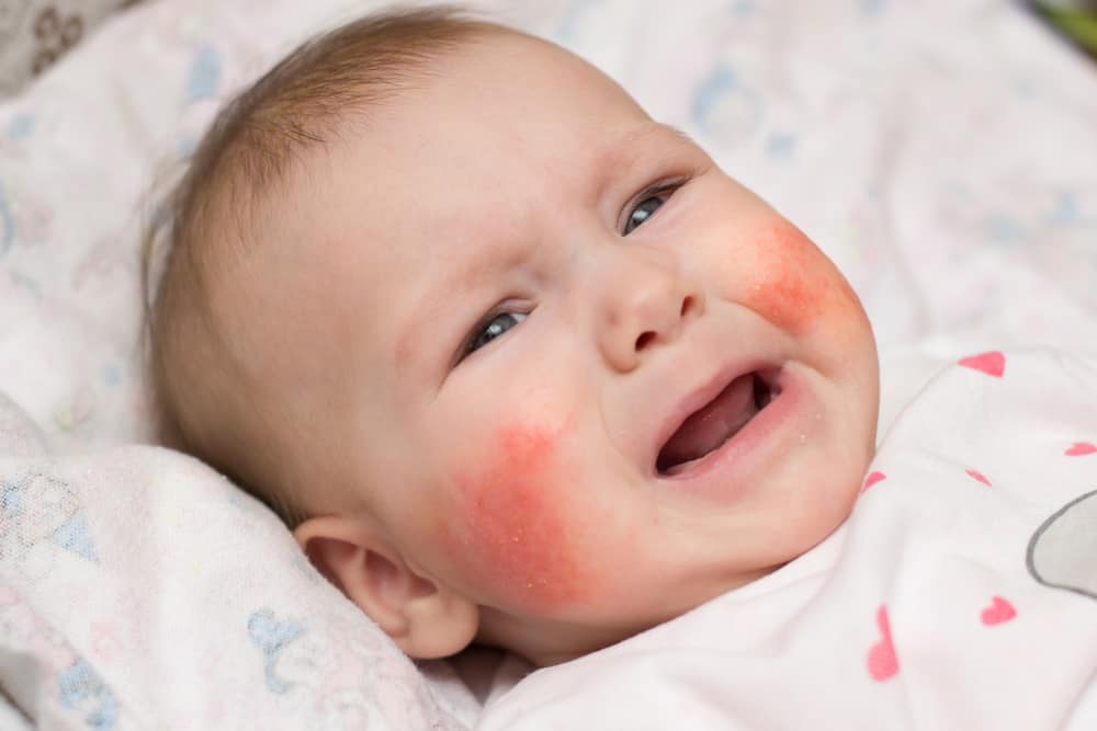 Gambar bayi yang mempunyai bintik ruam merah pada kulit wajahnya