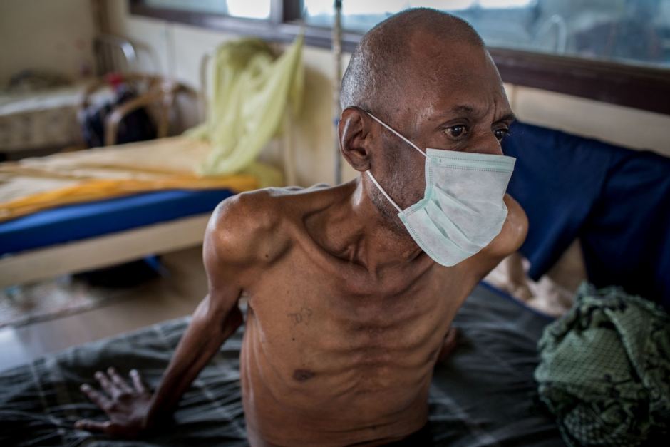 Gambar sinaran X paru-paru menunjukkan kesan jangkitan penyakit tibi (Tuberculosis).