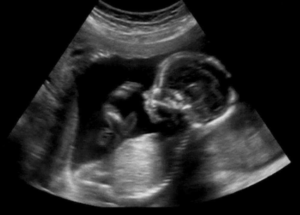 ultrasound