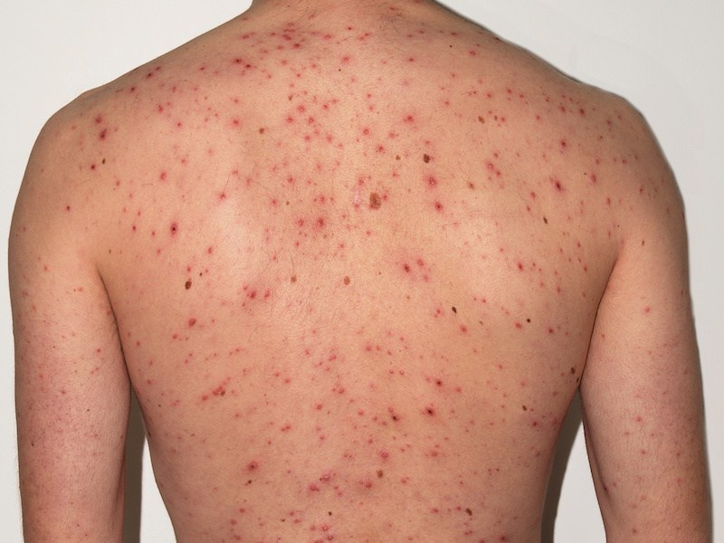 Gambar ruam merah pada kulit akibat jangkitan virus demam campak