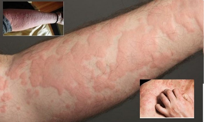 Gambar berkaitan rawatan moden untuk penyakit alahan (urticaria) yang sering disalah anggap ludah jin.